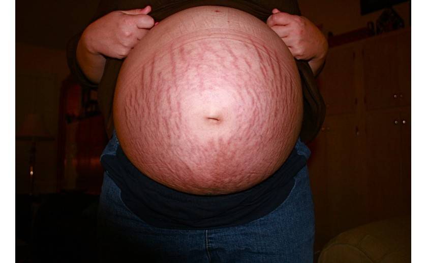 Cómo prevenir las estrías durante el embarazo 